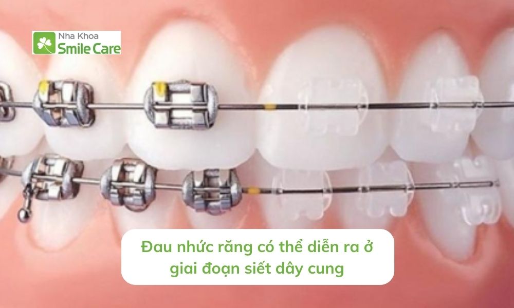 Đau nhức răng diễn ra ở giai đoạn siết dây cung.