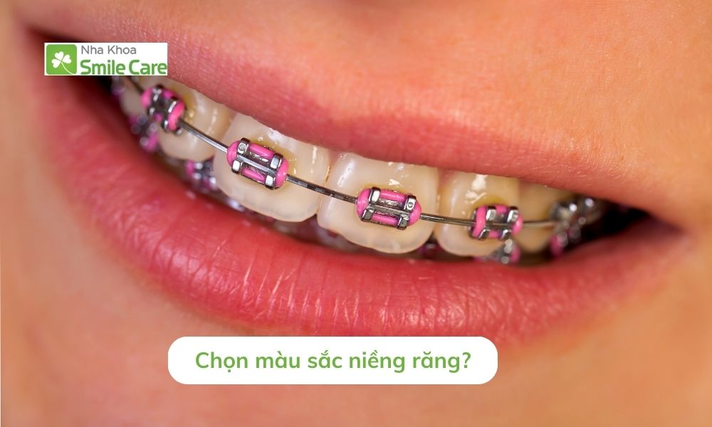 chọn màu sắc niềng răng