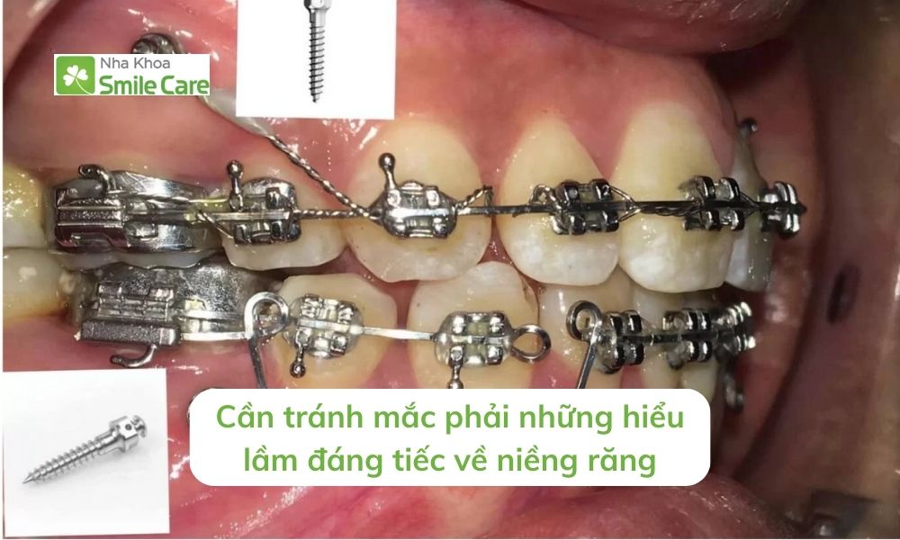 tránh mắc phải những hiểu lầm đáng tiếc về niềng răng