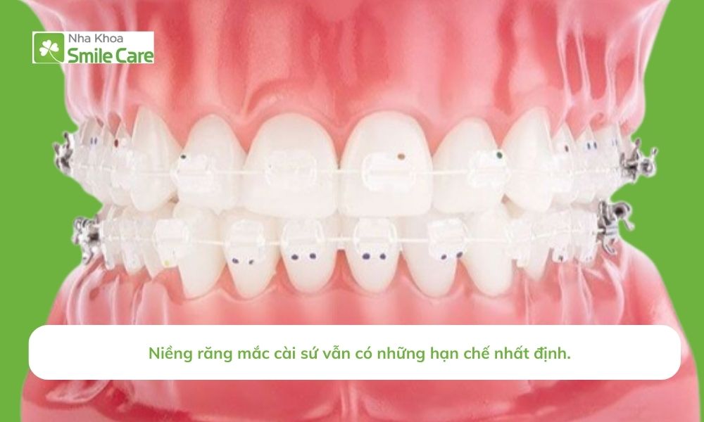 Mặc dù vậy, niềng răng mắc cài sứ vẫn có những hạn chế nhất định.