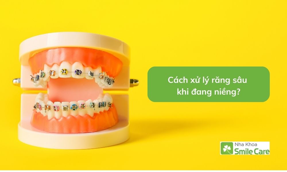 Cách xử lý răng sâu khi đang niềng
