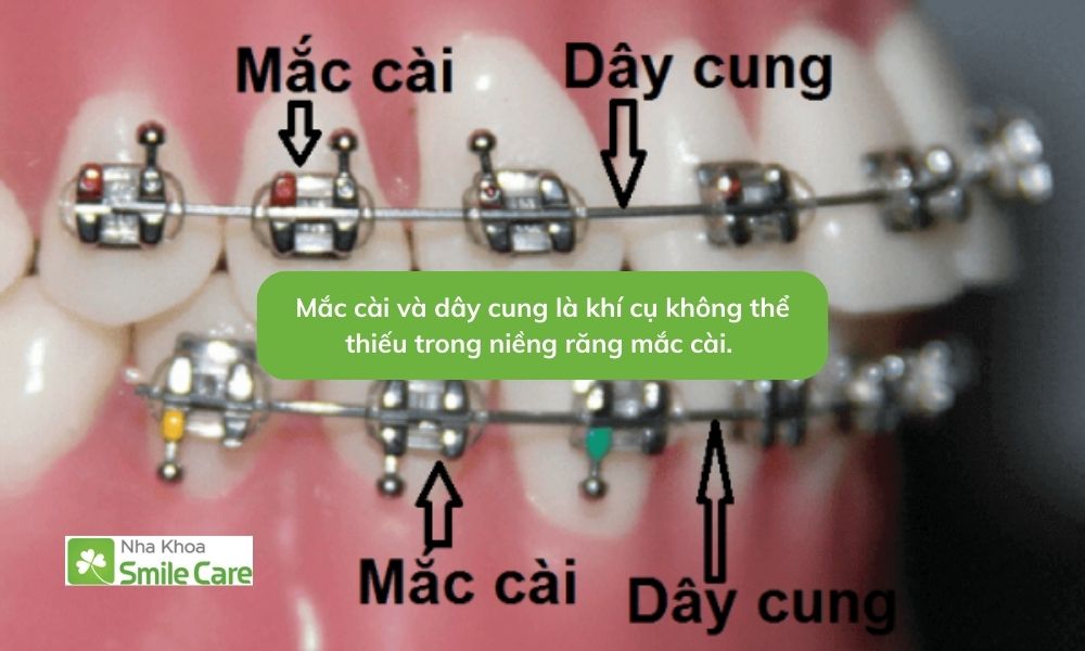 Mắc cài và dây cung là khí cụ không thể thiếu trong niềng răng mắc cài
