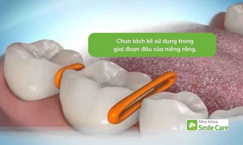 Chun tách kẽ sử dụng tại giai đoạn đầu của niềng răng.