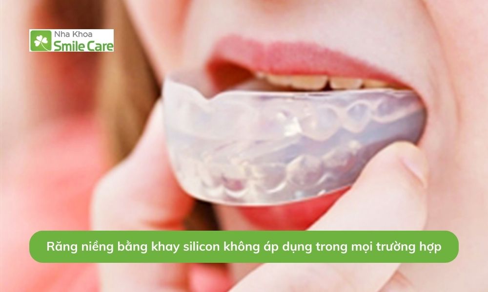Răng niềng bằng khay silicon không áp dụng trong mọi trường hợp