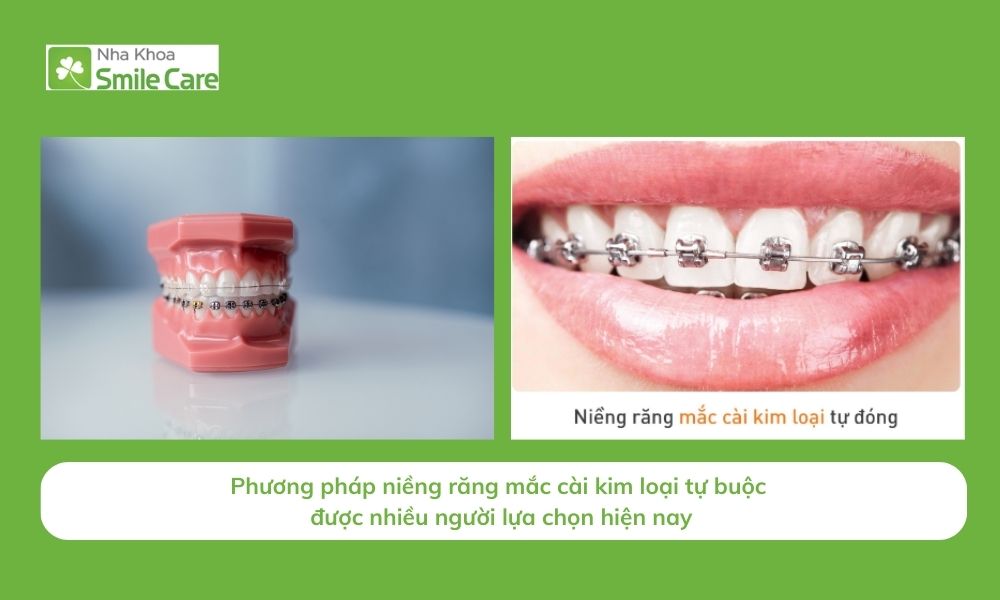 Phương pháp niềng răng mắc cài kim loại tự buộc được nhiều người lựa chọn