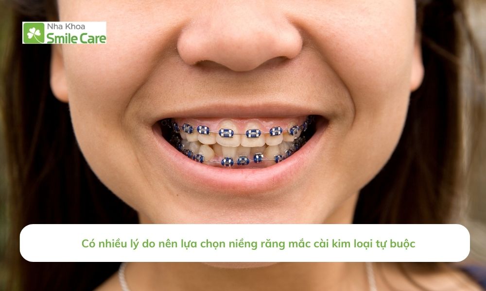 Nhiều lý do nên lựa chọn niềng răng mắc cài kim loại tự buộc