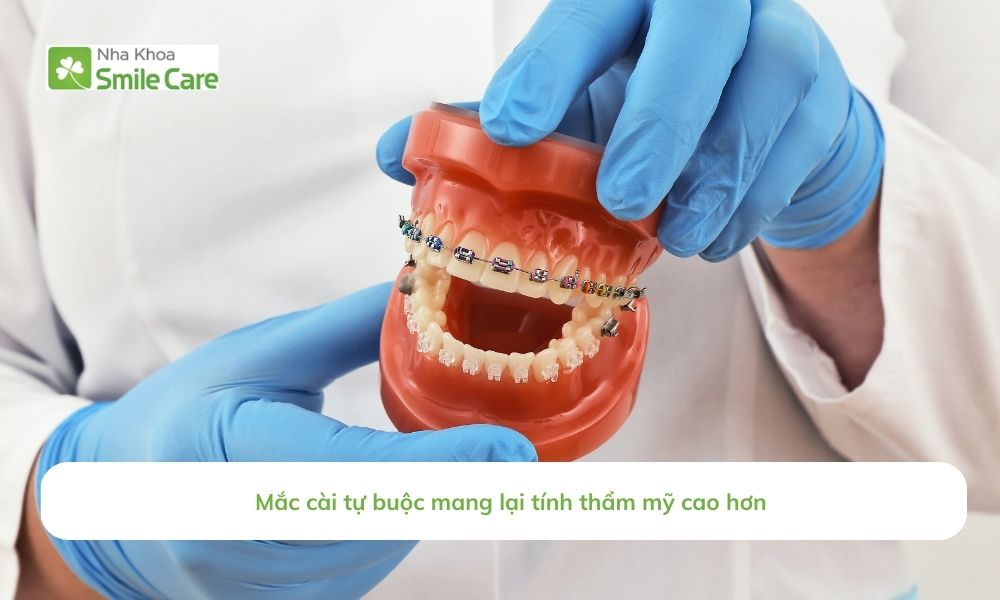 Mắc cài tự buộc mang lại tính thẩm mỹ cao