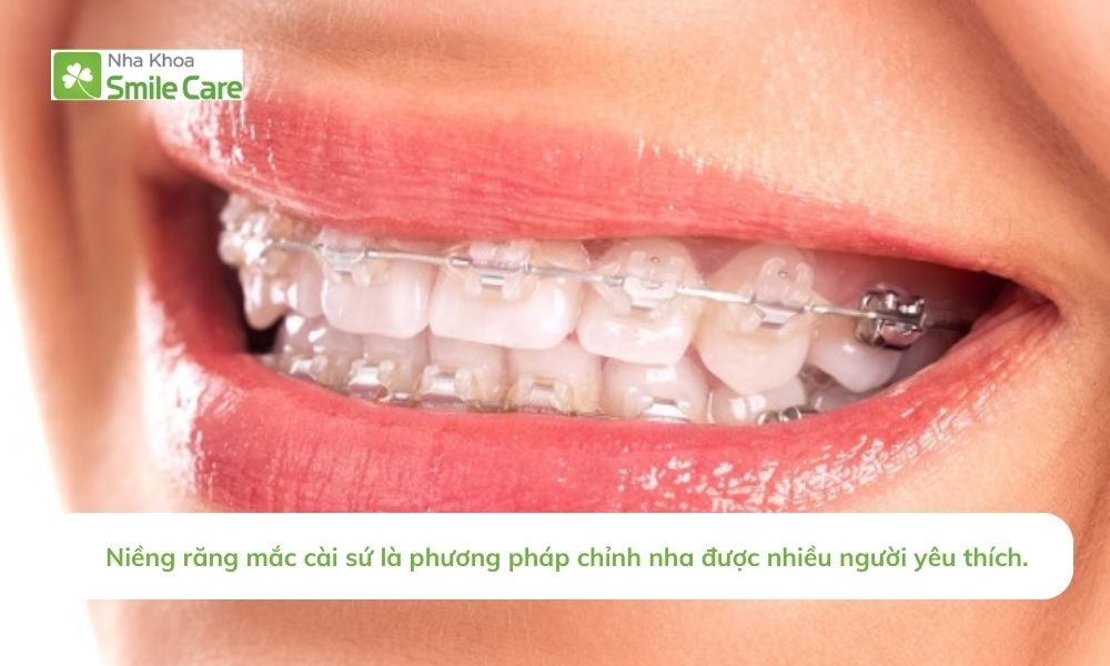 Niềng răng mắc cài sứ là phương pháp chỉnh nha phổ biến