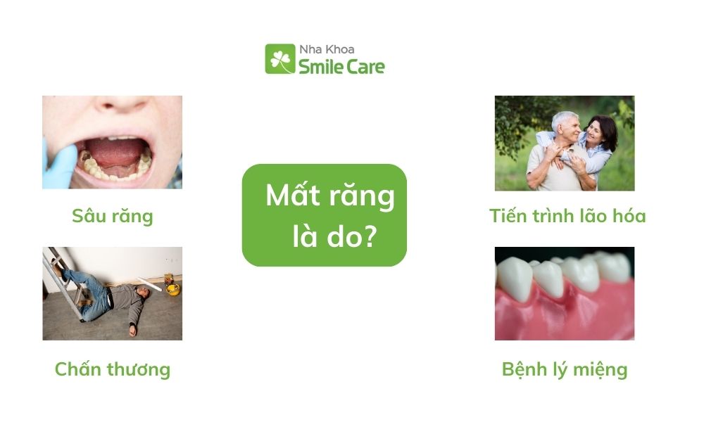 Mất răng do đâu?