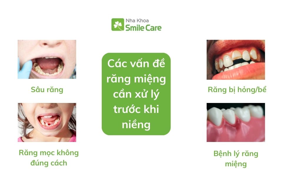 Các vấn đề cần xử lý trước khi niềng