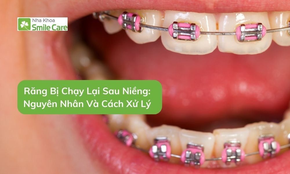 Răng Bị Chạy Lại Sau Niềng