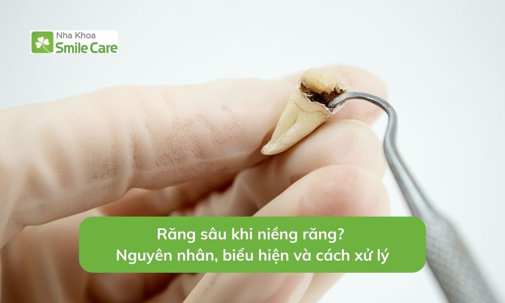 Răng sâu khi niềng răng?