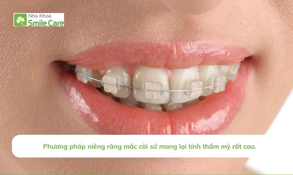 Phương pháp niềng răng mắc cài sứ mang lại tính thẩm mỹ cao.