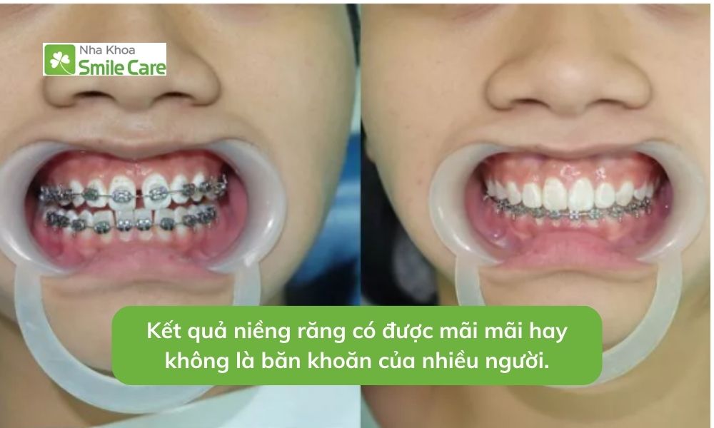 Kết quả niềng răng có được mãi mãi không là băn khoăn của nhiều người.