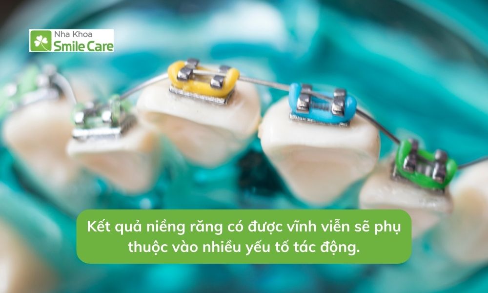 Kết quả niềng răng có được vĩnh viễn không