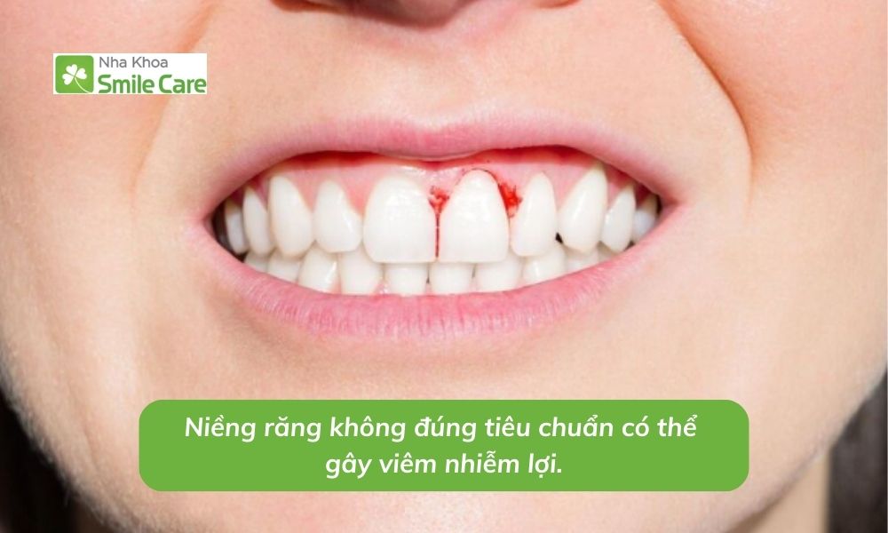 Niềng răng không đúng tiêu chuẩn có thể gây viêm nhiễm lợi