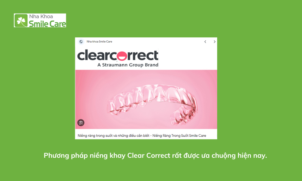 Phương pháp niềng khay Clear Correct rất được ưa chuộng